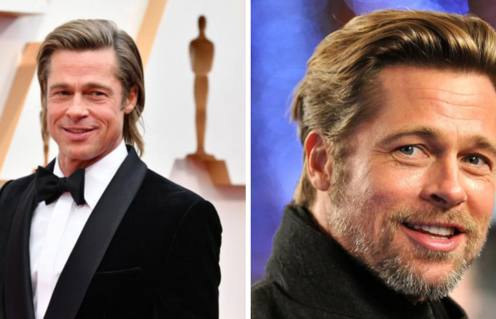 What actor had 5 hair transplants?