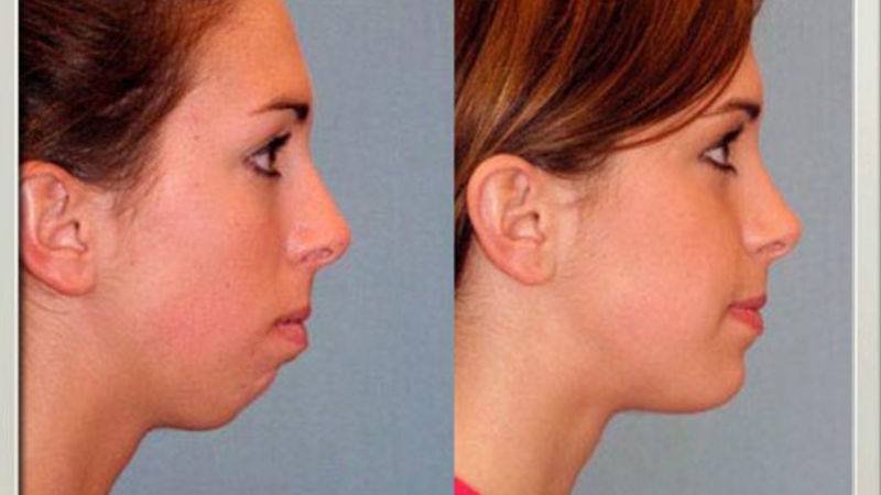 Chin Filler Before and after pictures