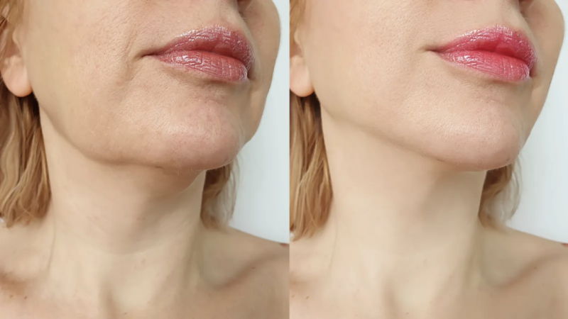 what are the results of chin filler